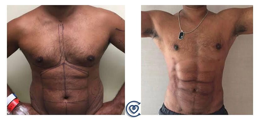 Before and After Result